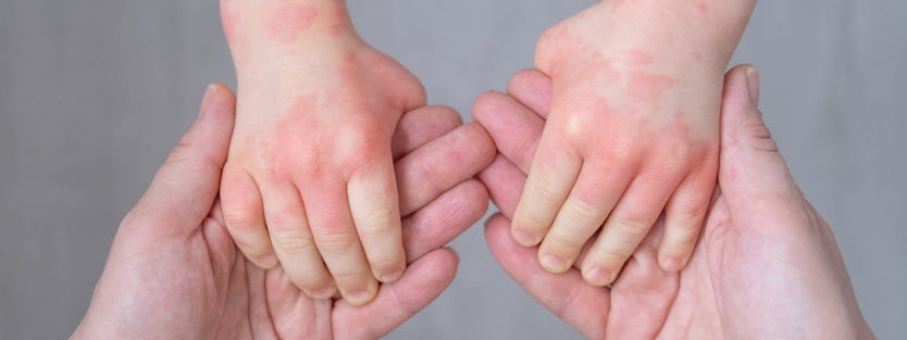 Toddler's hands with eczema holding parent's hands